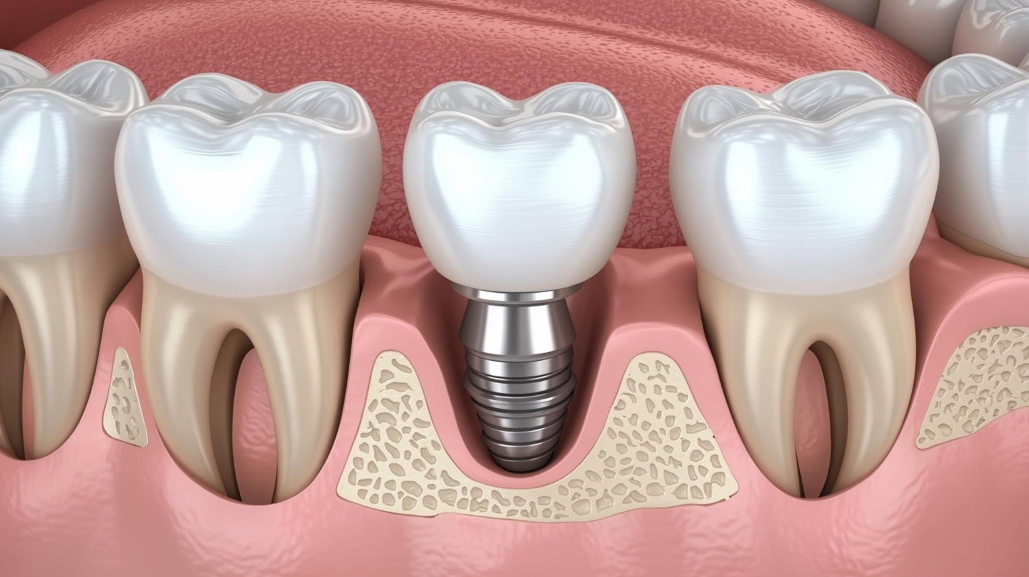 implantologia-dentale-a-bergamo